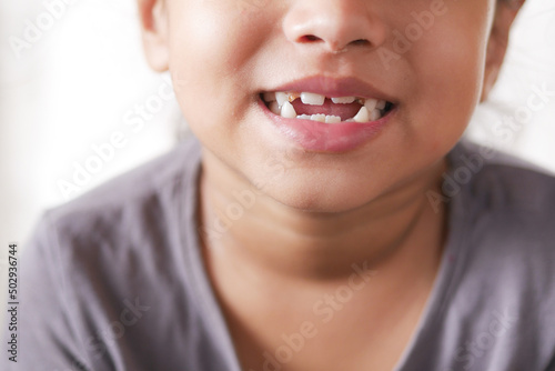 child girl smiling with deformed teeth 