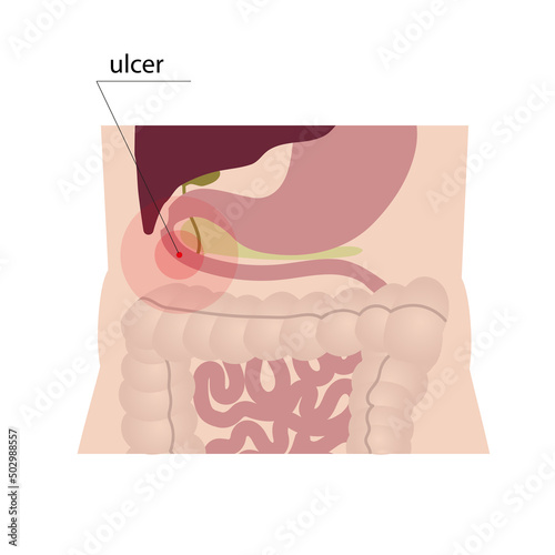 Schematic representation of a duodenal ulcer