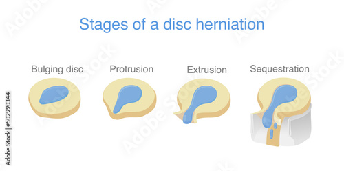 4 Stage of disc herniation. Medical diagram about spine problems that make back and neck pain.