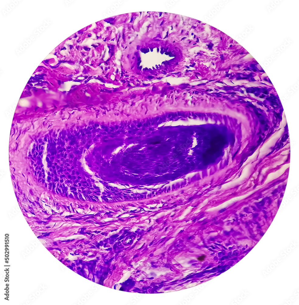 Skin Cancer: Skin biopsy under microscope showing Basal cell carcinoma. Skin Cancer: Skin biopsy under microscope showing Basal cell carcinoma.
