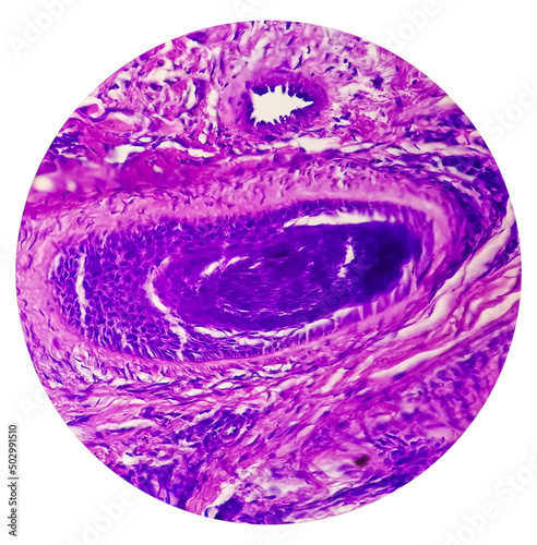 Skin Cancer: Skin biopsy under microscope showing Basal cell carcinoma. photo