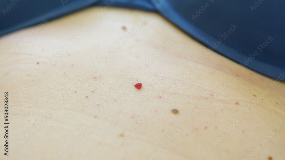 Red moles and dots on the female body. Large mole on stomach. Melanoma