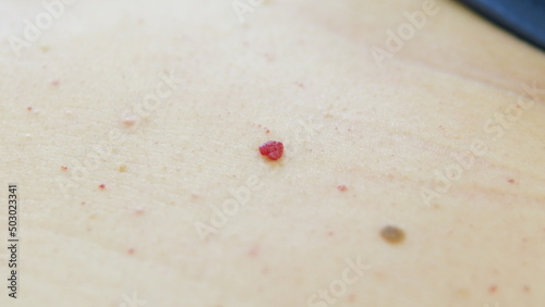 Red moles and dots on the female body. Large mole on stomach. Melanoma, hemangiomas, lipoma, atheroma, malignant and benign moles. Oncology. The medicine. Close-up photo, blurry.