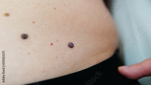 Red moles and dots on the female body. Large mole on stomach. Melanoma, hemangiomas, lipoma, atheroma, malignant and benign moles. Oncology. The medicine. Close-up photo, blurry.