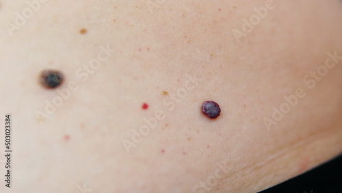 Red moles and dots on the female body. Large mole on stomach. Melanoma, hemangiomas, lipoma, atheroma, malignant and benign moles. Oncology. The medicine. Close-up photo, blurry. photo