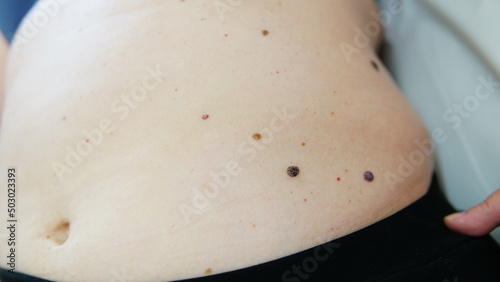 Red moles and dots on the female body. Large mole on stomach. Melanoma, hemangiomas, lipoma, atheroma, malignant and benign moles. Oncology. The medicine. Close-up photo, blurry.