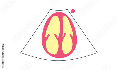 Diagram of right Ventricle enlargement of Apical 4-Chamber View of Echocardiography. Healthcare Concept