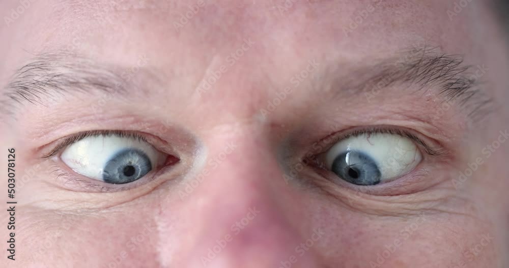 Closeup of male eyes with convergent strabismus 4k movie Closeup of male eyes with convergent strabismus 4k movie