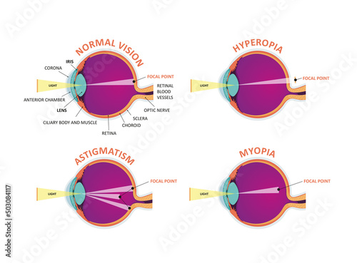 Eye defects. Normal vision, Hyperopia, Myopia.