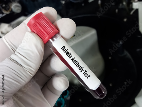 Blood sample for Rubella Antibody test, Rubella blood test.