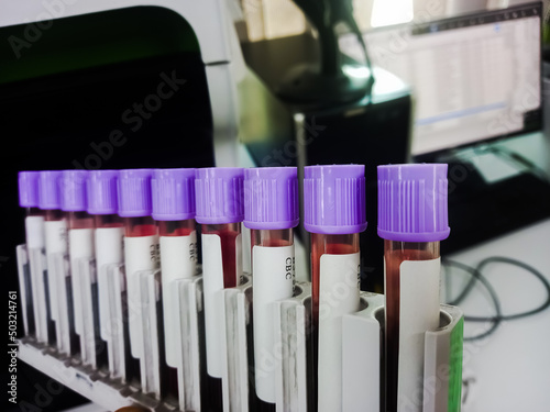 Blood test analysis labeled Complete Blood Count(CBC) with rack on machine.
