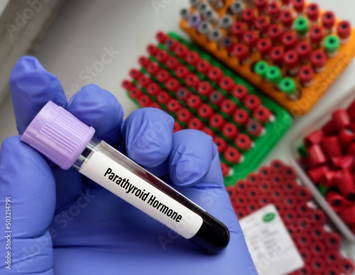 Test Tube with blood sample for Parathyroid Hormone (PTH) test, diagnosis for organ disease. A medical testing concept in the laboratory background. photo