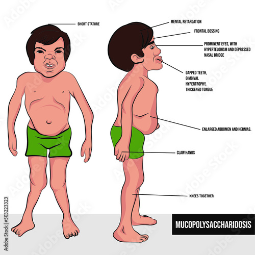 Mucopolysaccharidoses, are a group of rare (orphan) or low prevalence diseases considered degenerative in childhood.