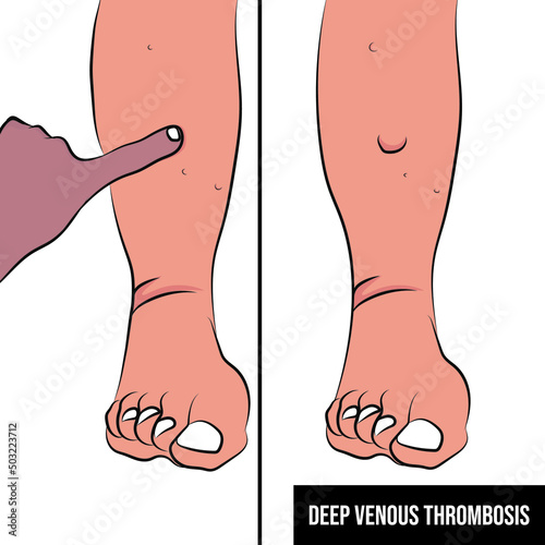Deep vein thrombosis (DVT) is a condition that occurs when a blood clot forms in a deep vein.