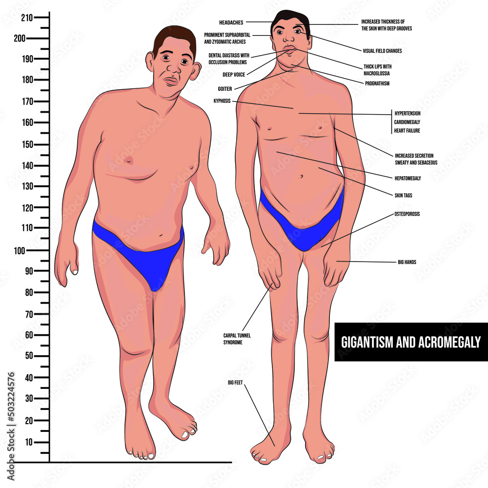 gigantism-and-acromegaly-are-syndromes-characterized-by-excessive