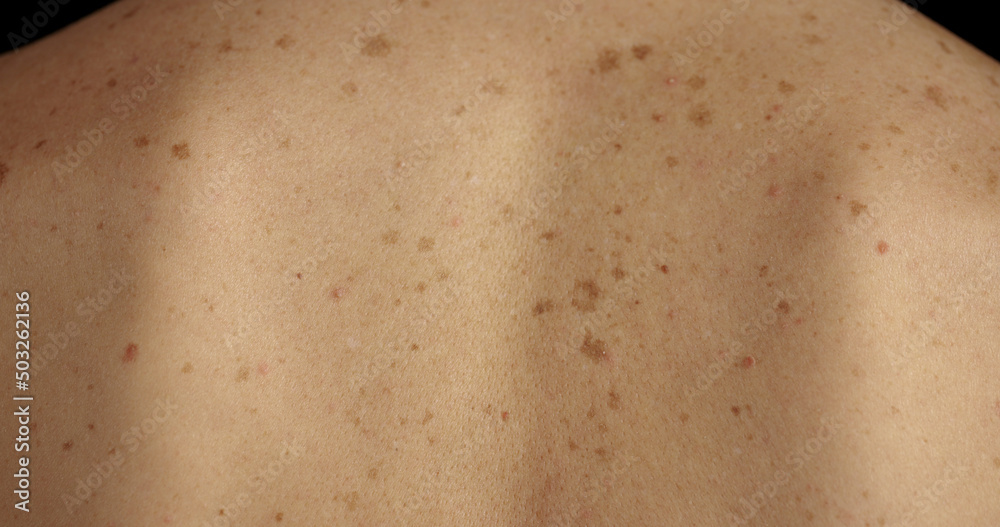 Fototapeta premium Close-up of large rashes or smallpox on the skin of an adult male. Pigmented spots on the back of a man. Skin of a man with moles. Acne.