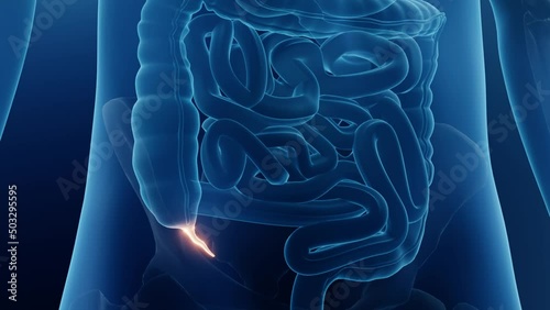 Appendix in human body close up, Appendicitis conceptual animation photo