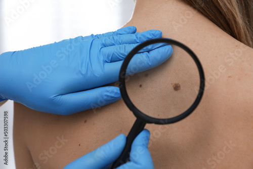 Dermatologist examining patient's birthmark with magnifying glass in clinic, closeup view