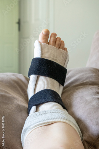 Close-up of a woman's foot which is injured and is wearing a brace and crutches