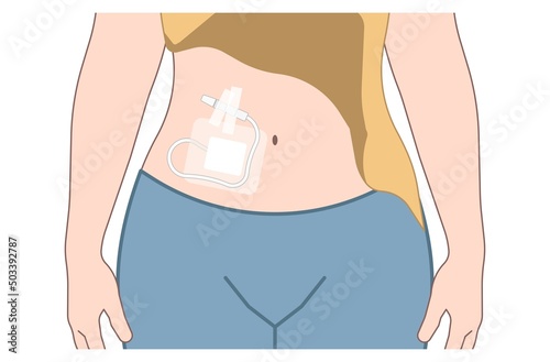 dialysate cleansing home care tube fluid drain bag waste High blood cysts center manual port End Stage renal ESRD Infusion Diffusion fatty liver tap cancer B C Use pain cavity portal peritoneocentesis