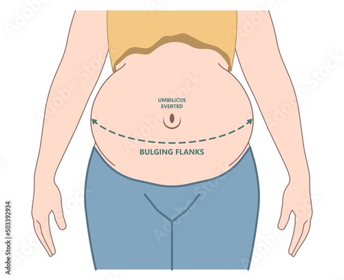 dialysate cleansing home care tube fluid drain bag waste High blood cysts center manual port End Stage renal ESRD Infusion Diffusion fatty liver tap cancer B C Use pain cavity portal peritoneocentesis