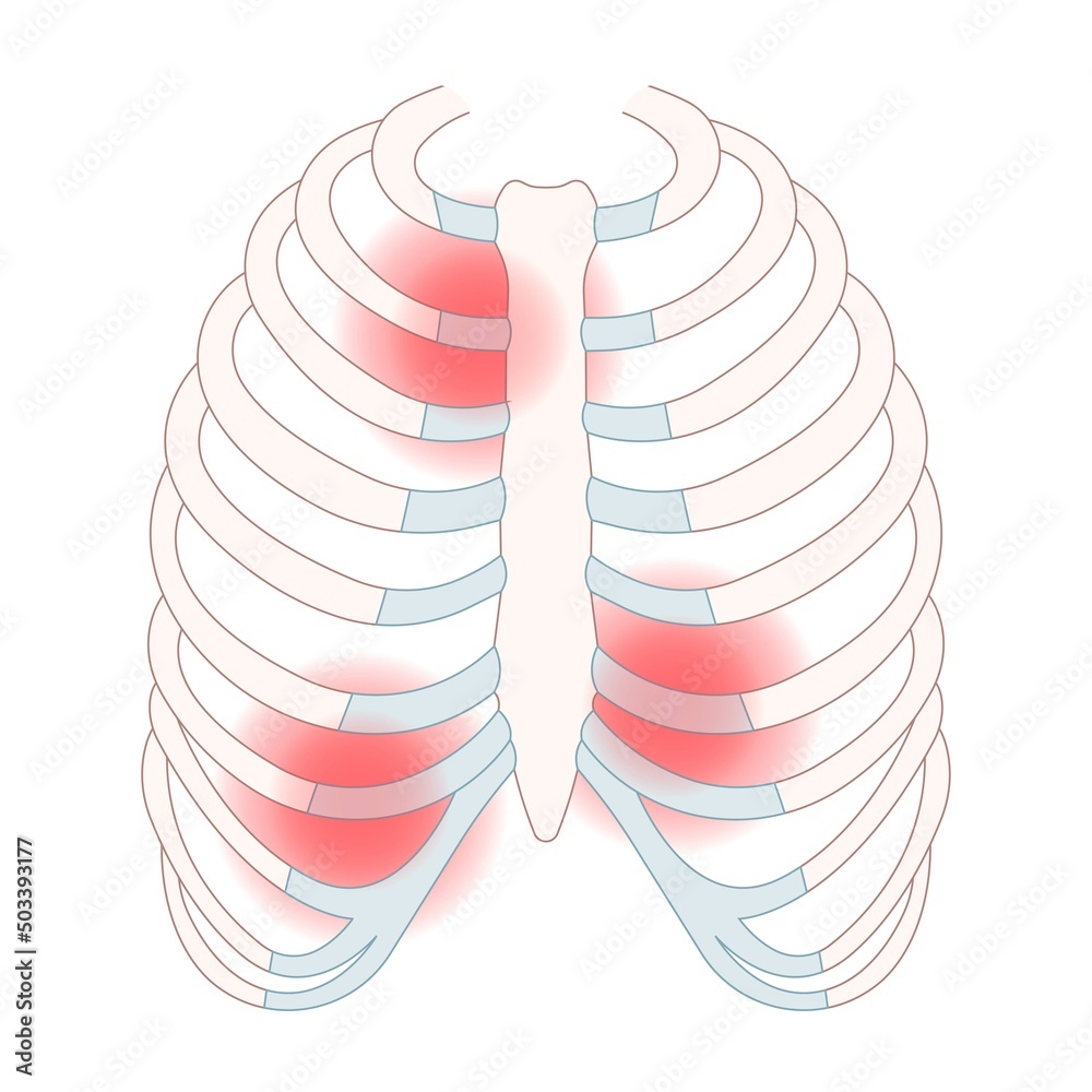 chest wall muscle rib fracture broken acute pain tietze syndrome bone