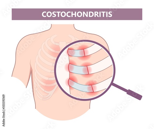 chest wall muscle rib fracture broken acute pain tietze syndrome bone joint tract deep breath or cough strain Virus bacteria Tumor Cancer overuse