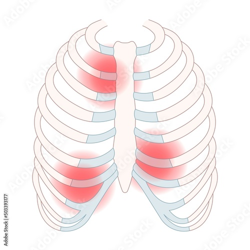 chest wall muscle rib fracture broken acute pain tietze syndrome bone joint tract deep breath or cough strain Virus bacteria Tumor Cancer overuse