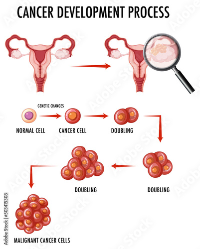 Diagram showing cancer in human ovary