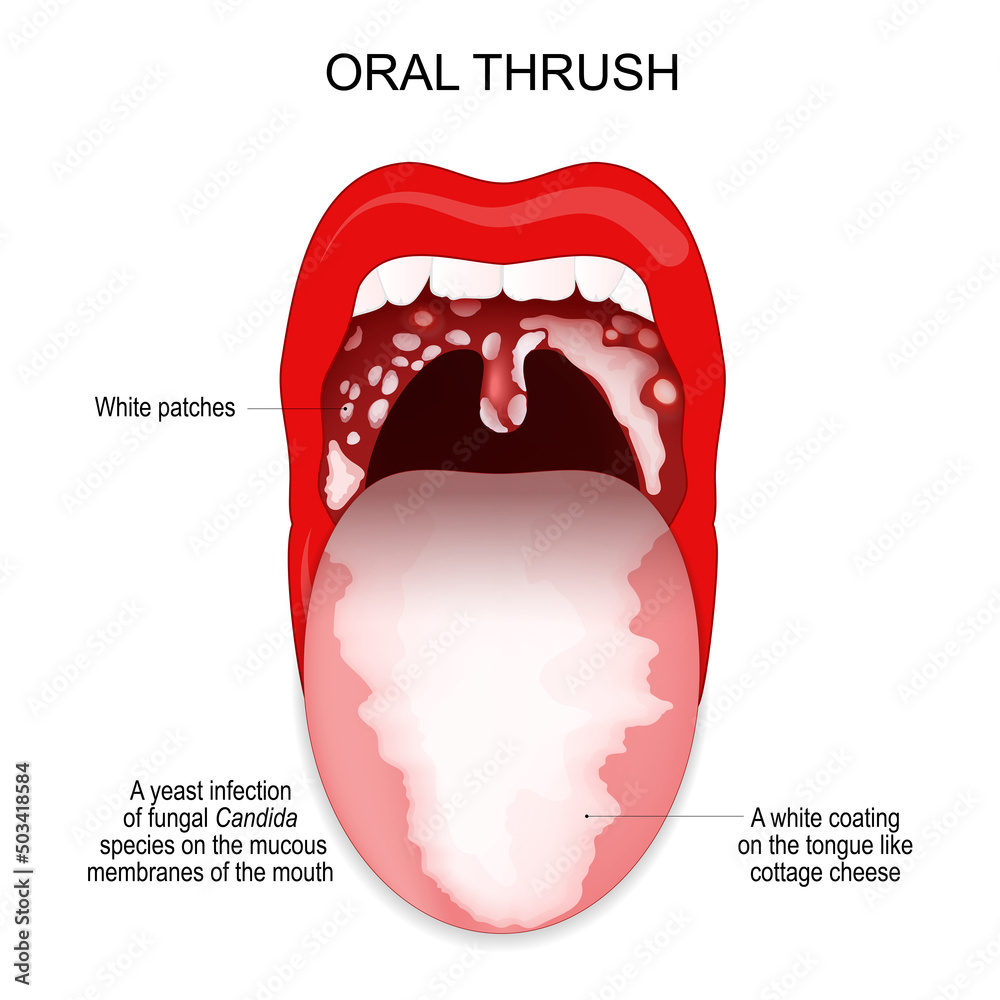 Stockvector Oral Thrush A White Coating On The Tongue And White