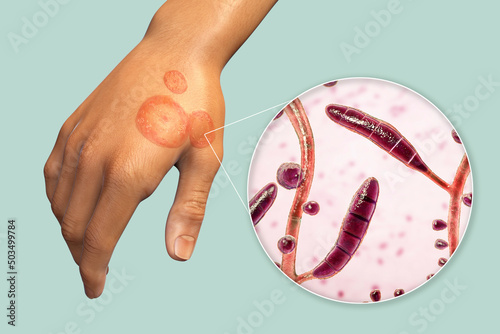 Fungal infection on a man's hand. Tinea manuum and close-up view of dermatophyte fungi, 3D illustration photo