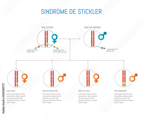Stckler syndrome, chromosome with mutation of the COL2A1 gene.