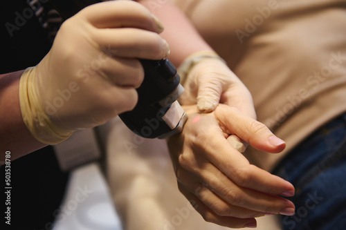 Removal of pigment spots and hair from the hands using a medical laser in a spa clinic