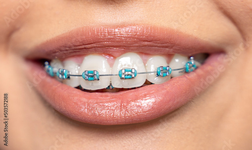 Closeup cropped shot, woman with dental braces 