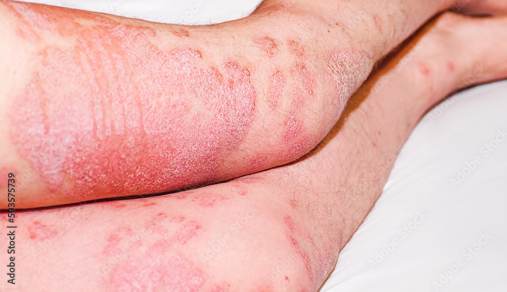 Acute psoriasis, severe reddening of the skin,an autoimmune,incurable dermatological skin disease.Large inflamed,scaly rash on man's legs.Red spots on the skin. Joints affected by psoriatic arthritis. Acute psoriasis, severe reddening of the skin,an autoimmune,incurable dermatological skin disease.Large inflamed,scaly rash on man's legs.Red spots on the skin. Joints affected by psoriatic arthritis.