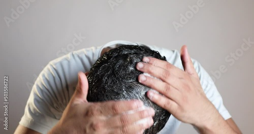 man using minoxidil foam for hair loss treatment, apply shampoo on scalp photo