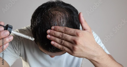 man using minoxidil on bald scalp to treat male pattern hair loss or androgenic alopecia photo