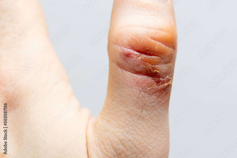 Fototapeta premium Chemical burn of a thumb finger. Household burn. An open deep wound. Damaged epidermis. Regeneration process. Close up view.