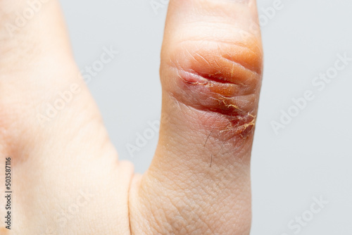 Chemical burn of a thumb finger. Household burn. An open deep wound. Damaged epidermis. Regeneration process. Close up view.