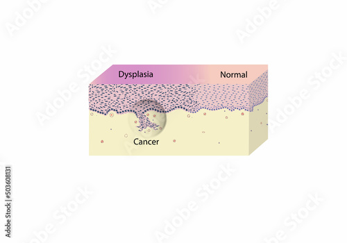 morphology of cervical cancer and dysplasia under a microscope, illustration, vector, eps