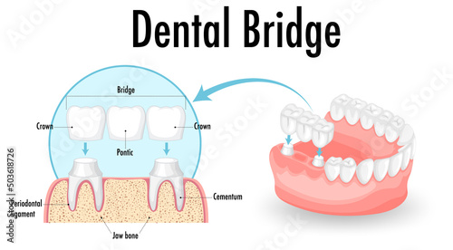 Infographic of human in dental bridge on white background