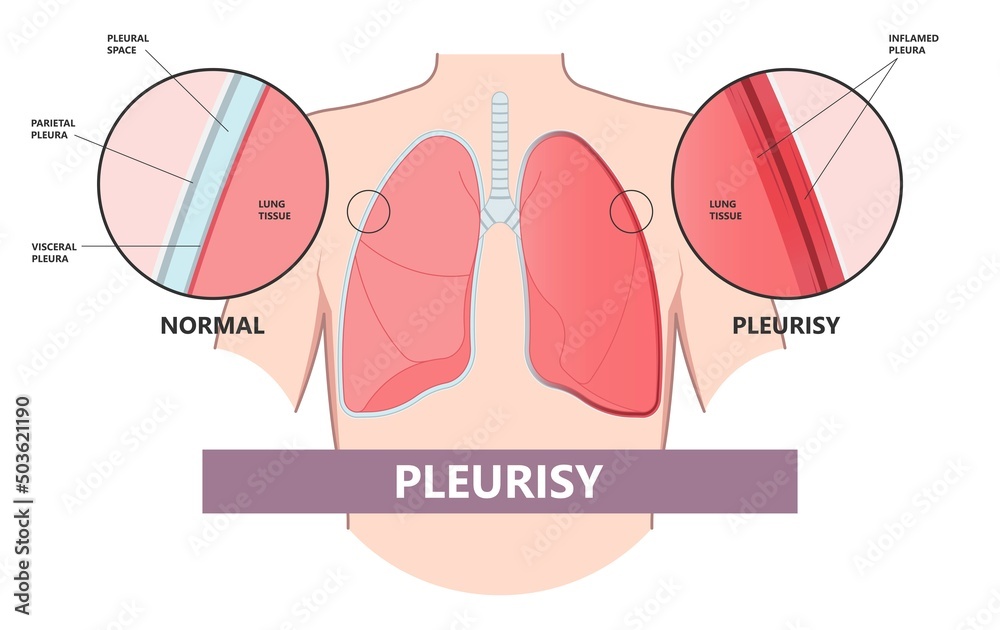 Pleurisy Lung covid 19 virus lupus pain chest xray fluid pleura