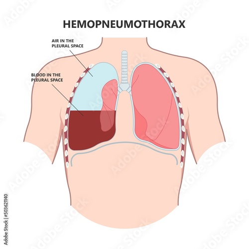Lung cancer collapse chest pain drain rib bleb blunt insert tube fluid care disease cystic surgery oxygen blood triangle of safety suction pleurisy bleeding pus failure edema placement Disease Therapy