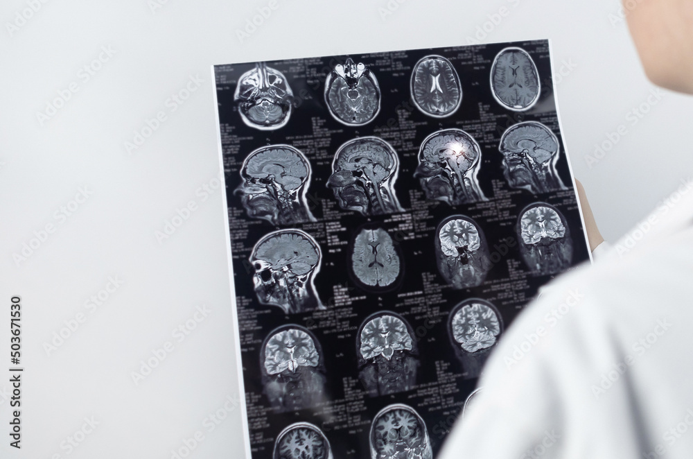 MRI of the brain. Neuropathologist holds a picture against the ...