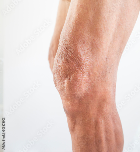 Leg and knee of an old man with synovial problems on a white background © yongyut