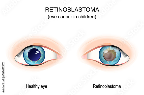 Retinoblastoma. eye cancer