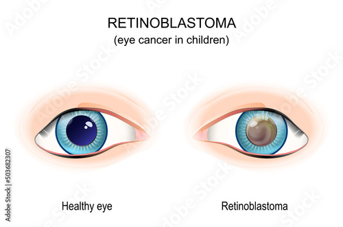 Retinoblastoma. eye cancer