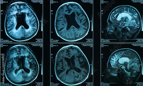 A snapshot of an elderly person's brain scan on magnetic resonance imaging MRI film, for neurological medical diagnosis of brain diseases