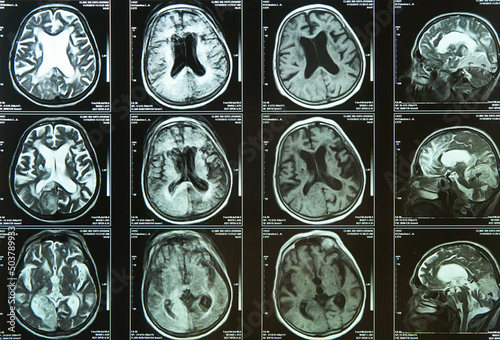 A snapshot of an elderly person's brain scan on magnetic resonance imaging MRI film, for neurological medical diagnosis of brain diseases