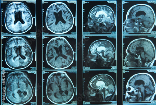 A snapshot of an elderly person's brain scan on magnetic resonance imaging MRI film, for neurological medical diagnosis of brain diseases